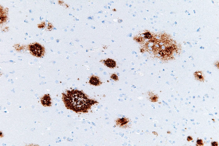 Stained section of brain with amyloid highlighted in brown, showing amyloid plaques in high magnification. The background nerve tissue is blue.