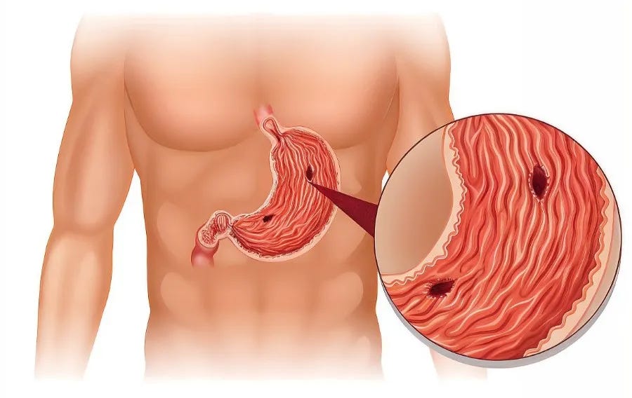 Stomach Ulcers