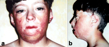 Aesthetic reconstruction of the severely disfigured burned face: a creative  strategy for a “natural” appearance using pre-patterned autogenous free  flaps | Burns & Trauma | Full Text