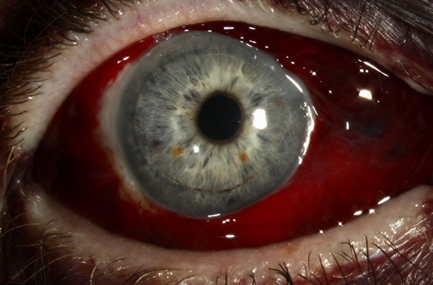 Subconjunctival hemorrhage example - Sione Vaki