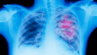 X-ray of lung showing chest cancer.