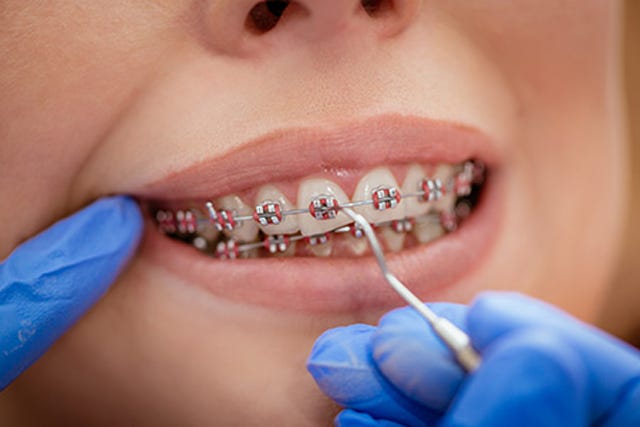 Putting on Braces: How Are Braces Put On? - Embrace Family