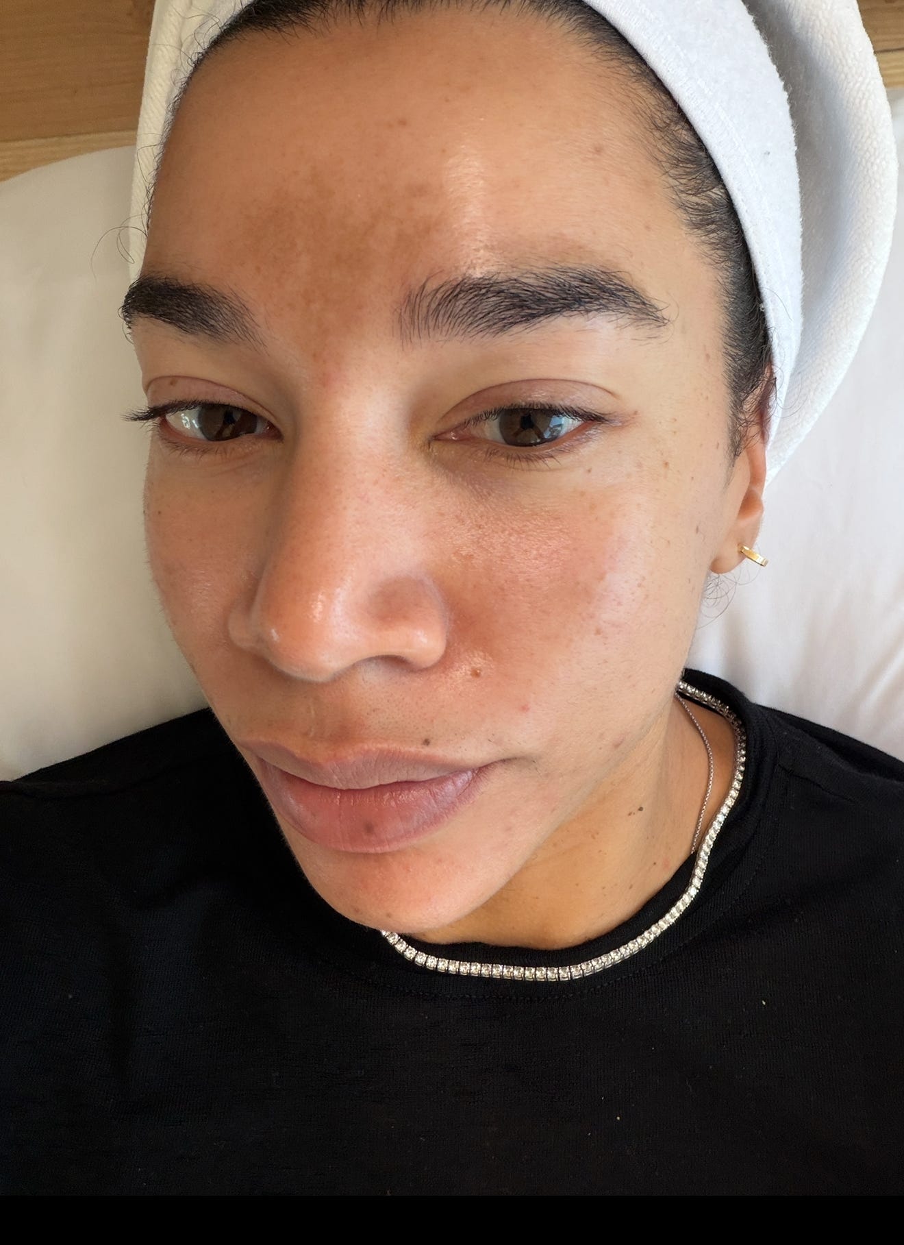 glutathione mesotherapy for melasma Melasma (and microneedling), 15 months later