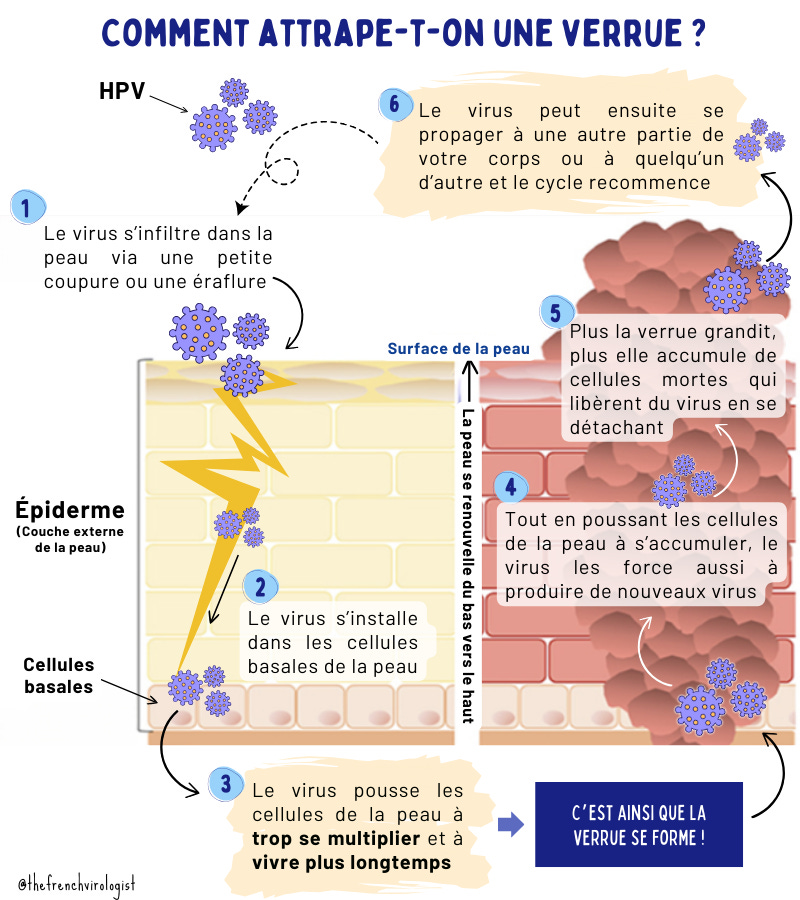Traitement Naturel Contre Verrues Et Papillomes - Gel à Base De Plantes - Neuf
