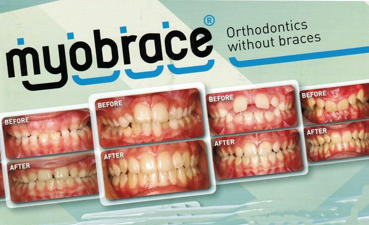 Myobrace In Aurora, IL | Young Dental Care