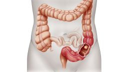 colon cancer vls
