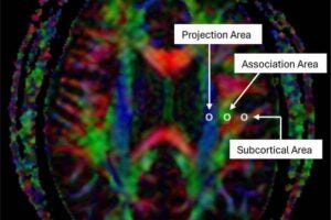 The brain’s waste-clearing system shows a marked decline in function after repeated head impacts, according to a new study of cognitively impaired professional boxers and mixed martial arts fighters. A color map from diffusion tensor imaging illustrates the distribution of key fiber pathways, with projection fibers shown in blue (z axis), association fibers in green (y axis), and subcortical fibers in red (x axis). Three regions of interest are positioned within each fiber type to measure direction-specific diffusivity along the x, y, and z axes.