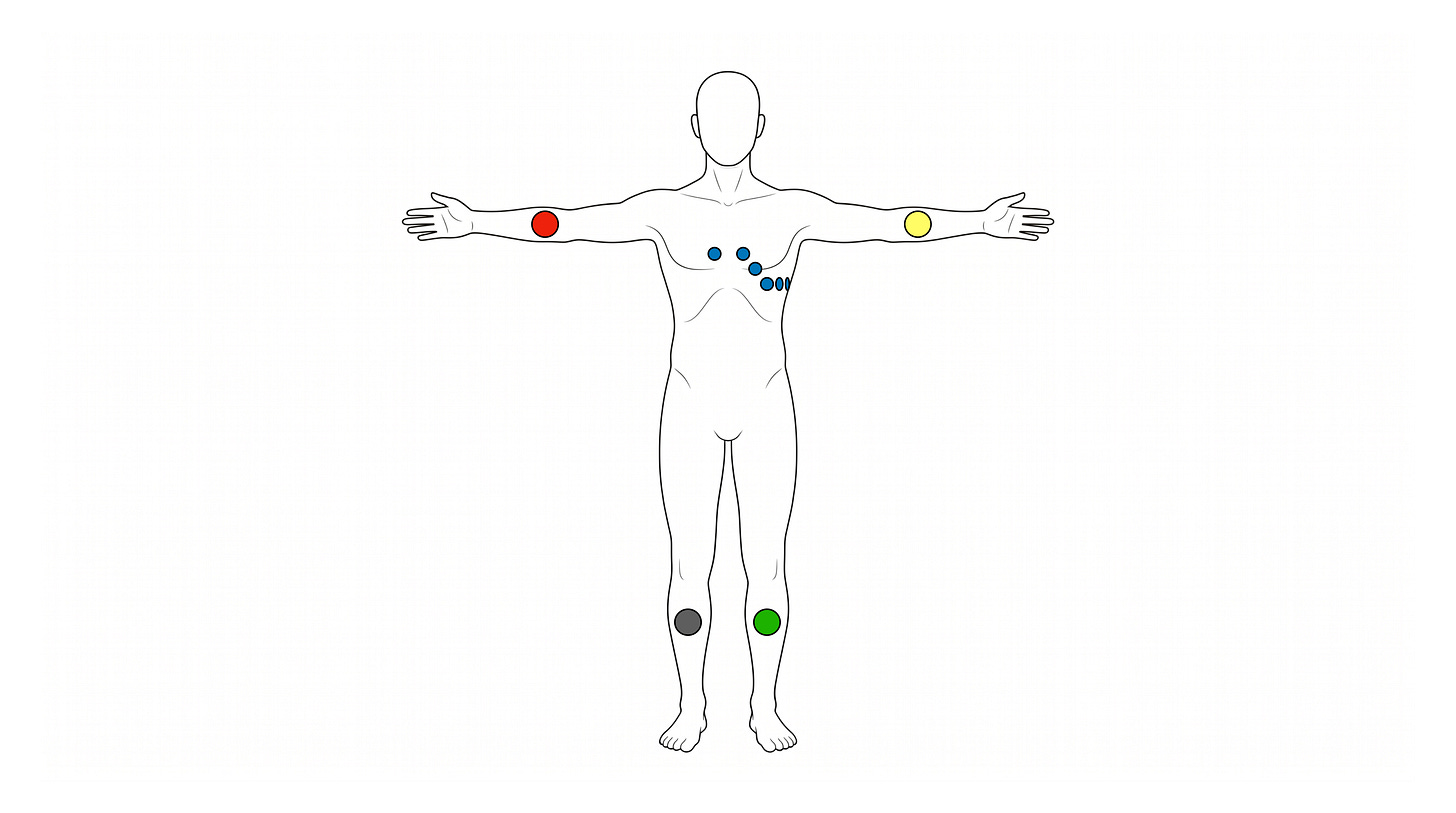 Front-view schematic of a human torso with ten ECG electrodes. Four limb electrodes are shown as coloured dots: a red dot on the right upper arm (RA), a yellow dot on the left upper arm (LA), a green dot on the left lower leg (LL), and a black dot on the right lower leg (N/RL). Six smaller blue dots run across the chest representing the precordial leads V1–V6. No text labels are drawn on the figure.