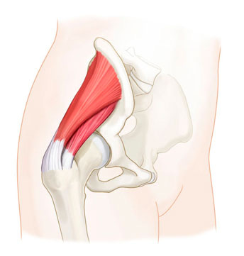 Gluteal Tendinopathy: Managing Your Hip Pain