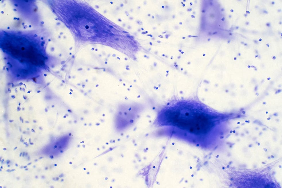 Forensic Slide of Deceased Neurons, without Tight Connectivity and Electric Affinity of Living State, and thus Farther Separated (stock agency photograph) Forensic Slide of Deceased Neurons, without Tight Connectivity and Electric Affinity of Living State, and thus Farther Separated (stock agency photograph)
