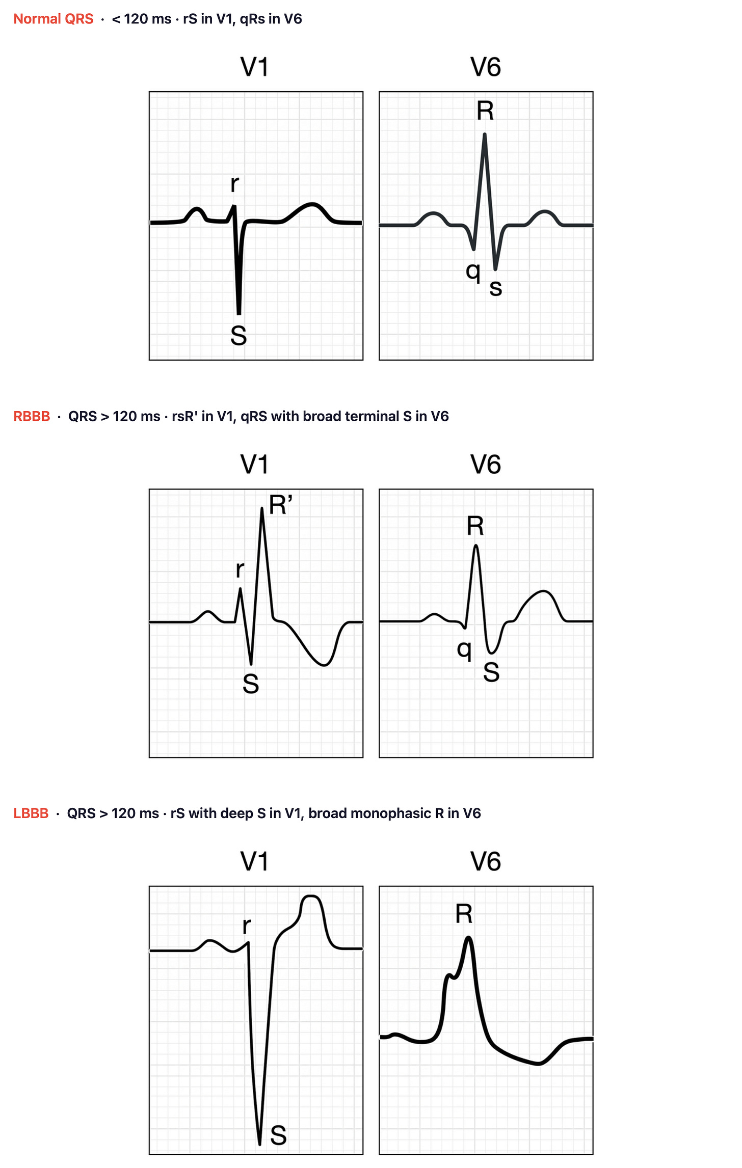 QRS in V1 and V6 compared: normal (rS, qRs), RBBB (rsR', qRS with broad S), and LBBB (rS, broad R)