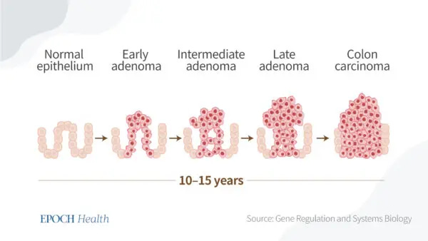 It takes 10–15 years for colon carcinoma to form. (The Epoch Times) It takes 10–15 years for colon carcinoma to form. (The Epoch Times)