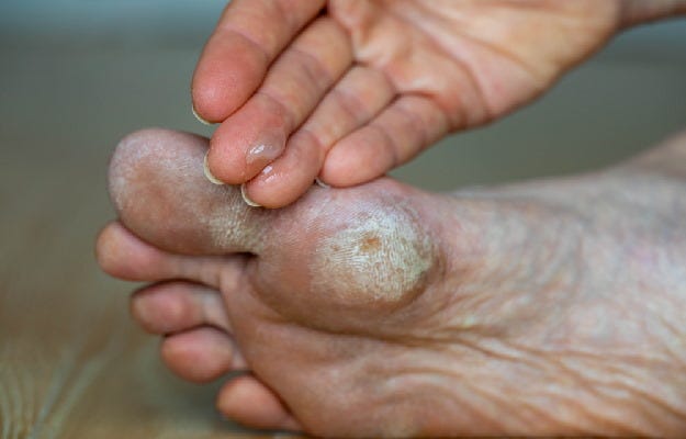 Hyperkeratosis: Skin Problems and Diagnosis