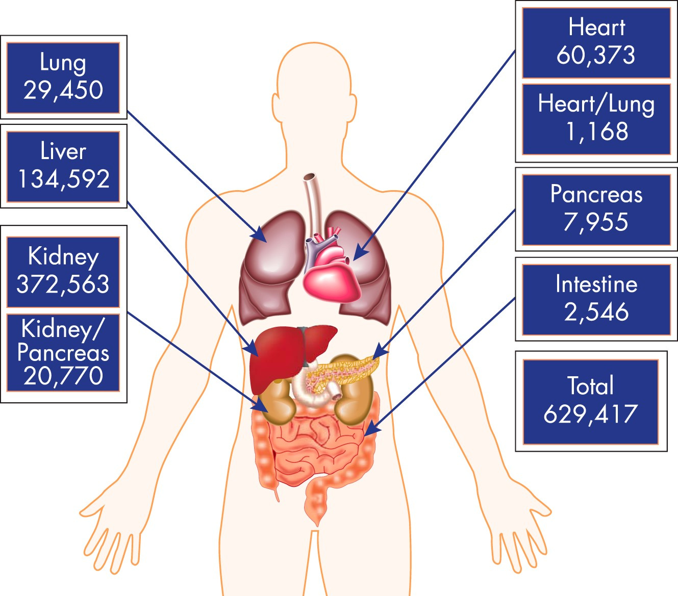 Numbers represent transplants performed from January 1988 to March 31, 2015, and reported to the United Network for Organ Sharing. Numbers represent transplants performed from January 1988 to March 31, 2015, and reported to the United Network for Organ Sharing.
