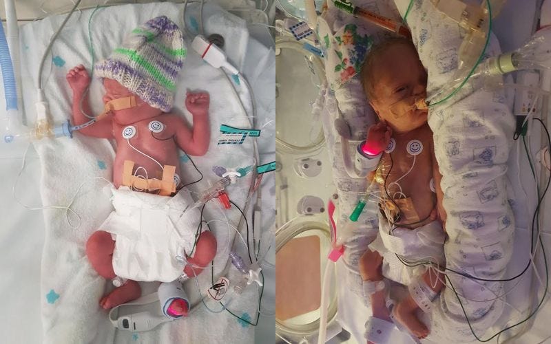 triplets with surviving fraternal twins