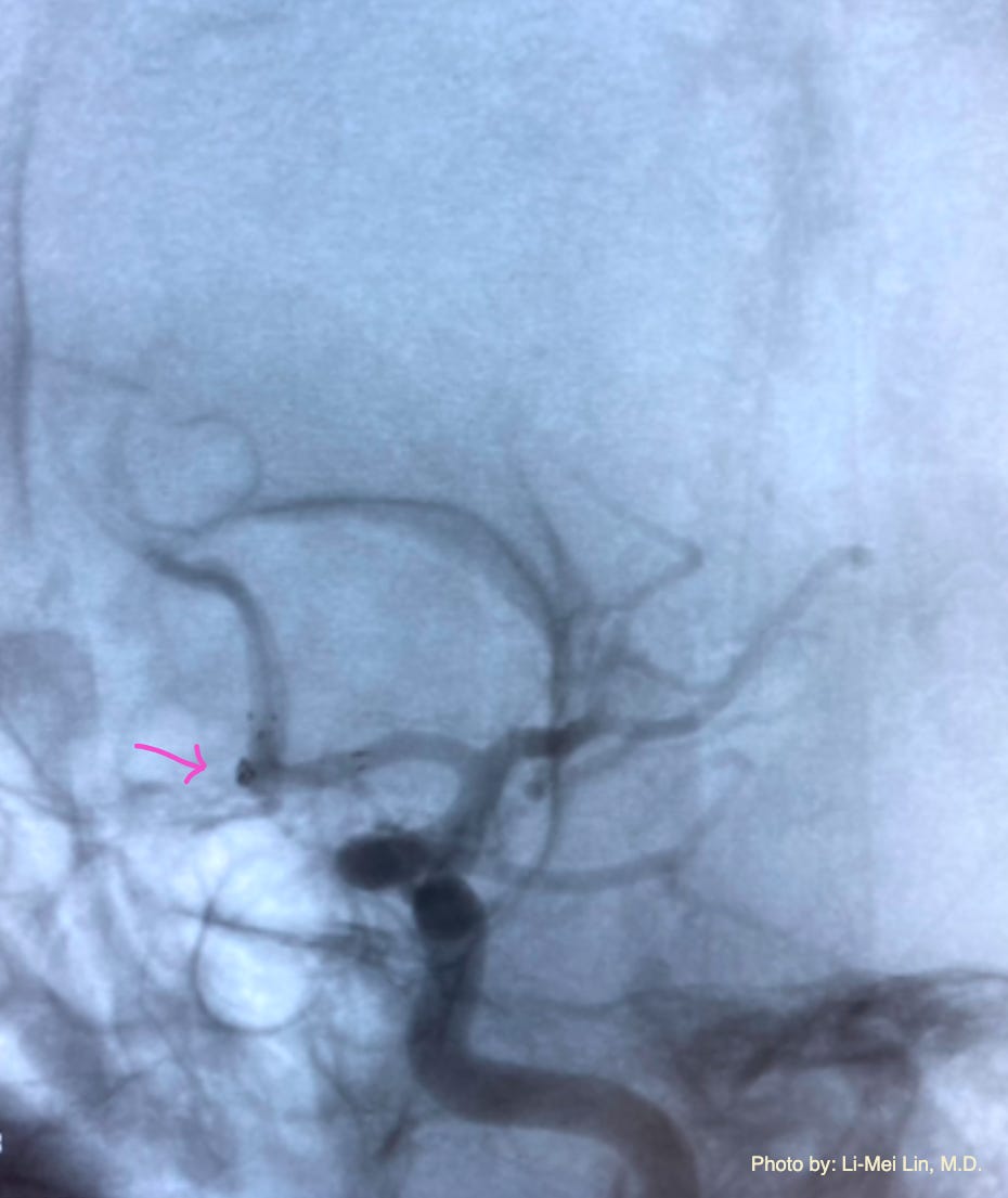 Brain aneurysm stent coil by Li-Mei Lin, M.D.