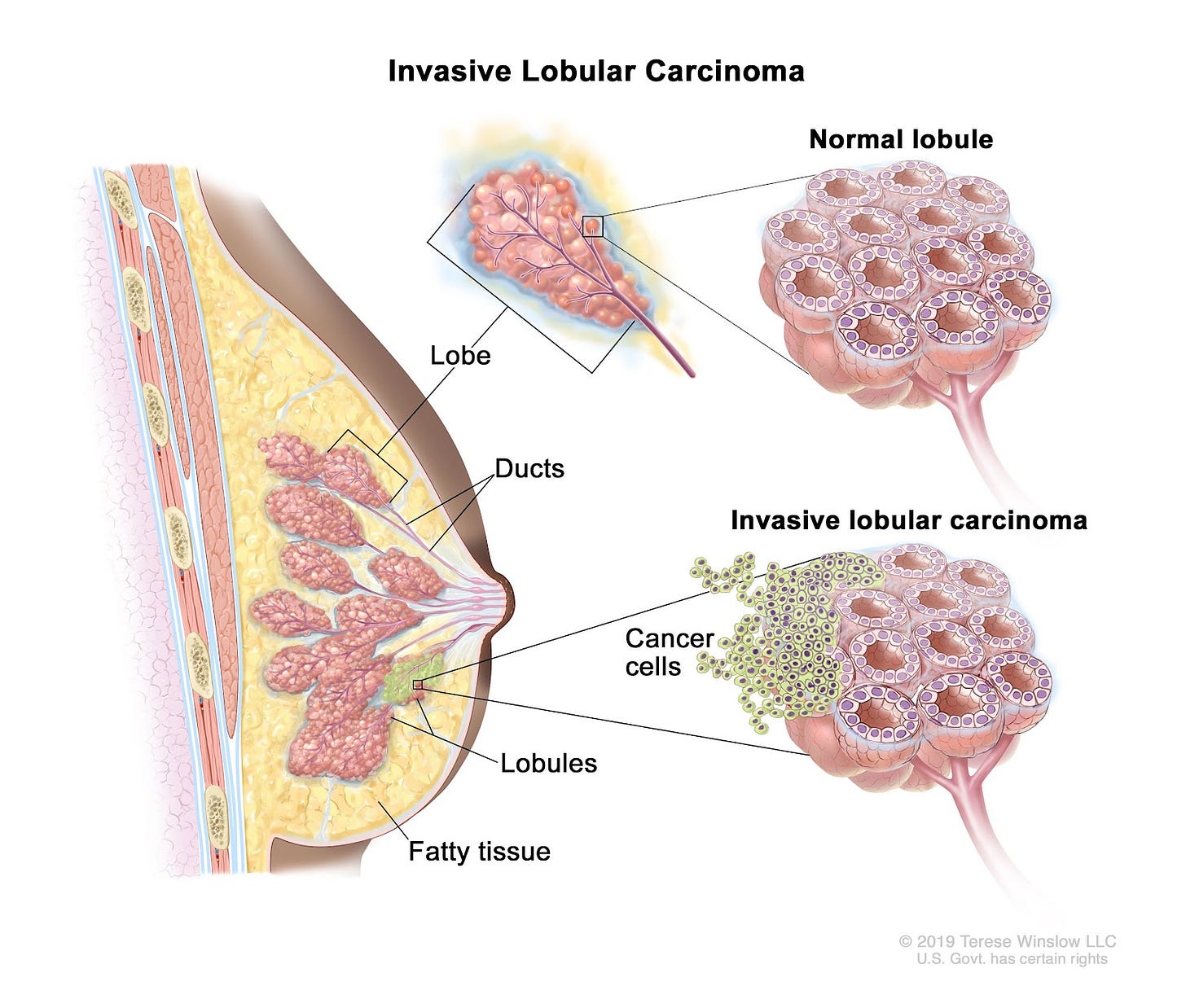 Definition of invasive lobular carcinoma - NCI Dictionary of Cancer Terms - NCI Definition of invasive lobular carcinoma - NCI Dictionary of Cancer Terms - NCI