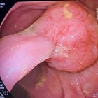 Quiz: Colon Polypectomy – What Additional Tools or Techniques Would You Use to Resect This Polyp?