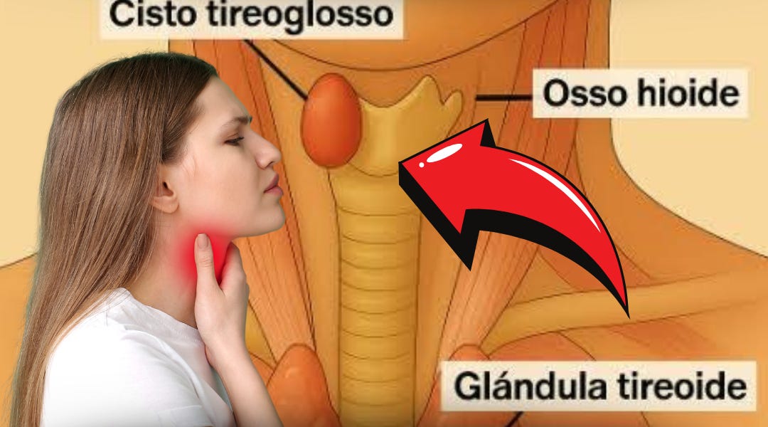 Cisto na tireoide: o que é, sintomas, causas e tratamento