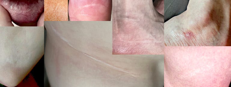 A selection of some of Pete Jorgensen's scars, from top left to bottom right: lip, arm, thumb, right ankle, left ankle, elbow, hip, thigh.