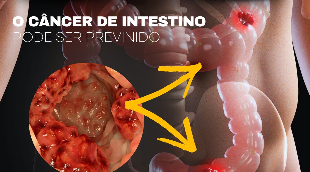 Como Saber Se Tenho Cancer No Intestino