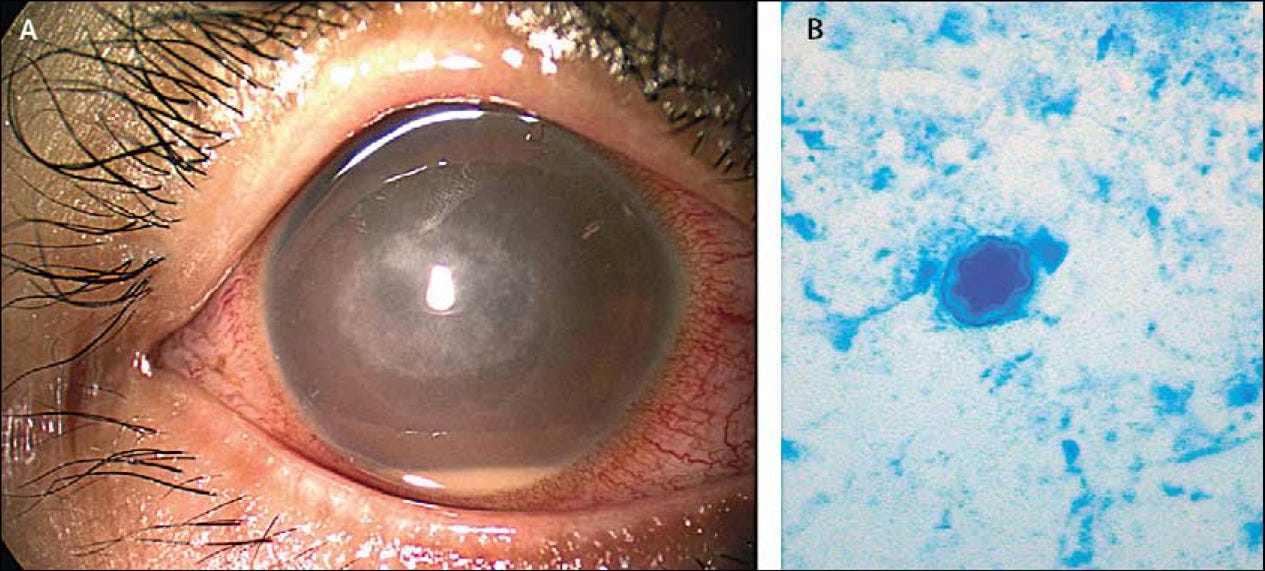 Eye Infection [Patient Goes Blind]