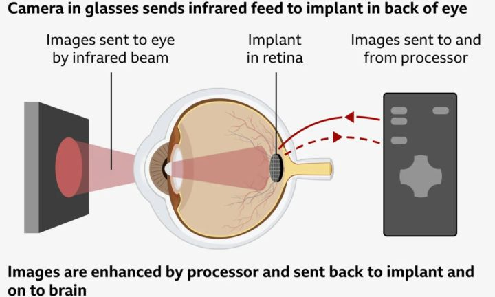 How the implant works