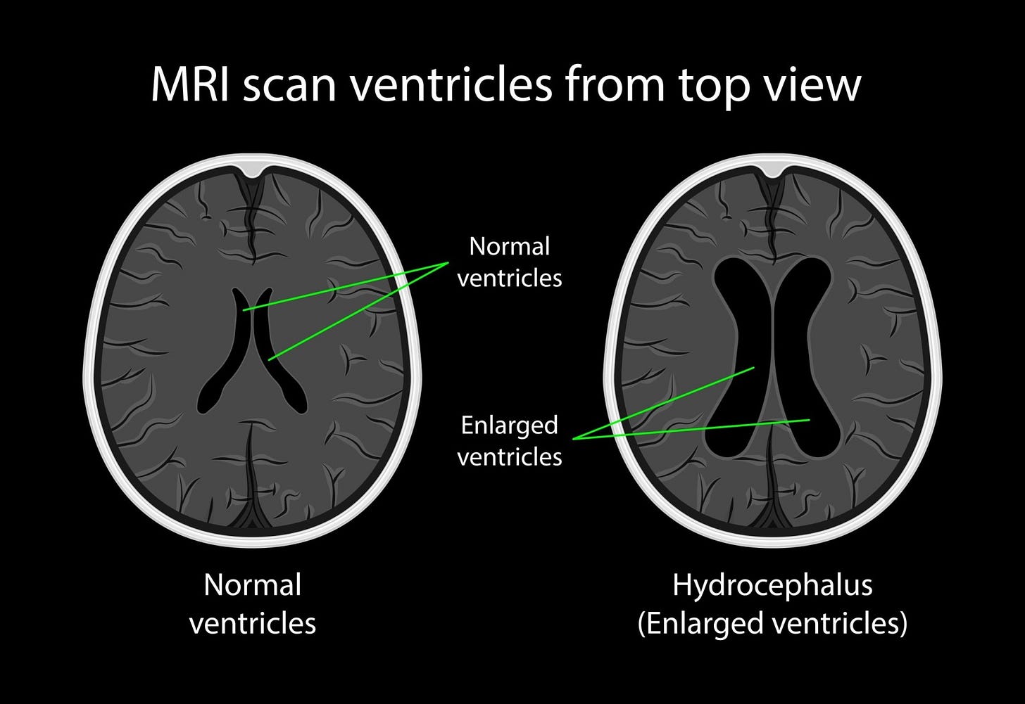 Expert Care for Normal Pressure Hydrocephalus in Los Angeles Expert Care for Normal Pressure Hydrocephalus in Los Angeles