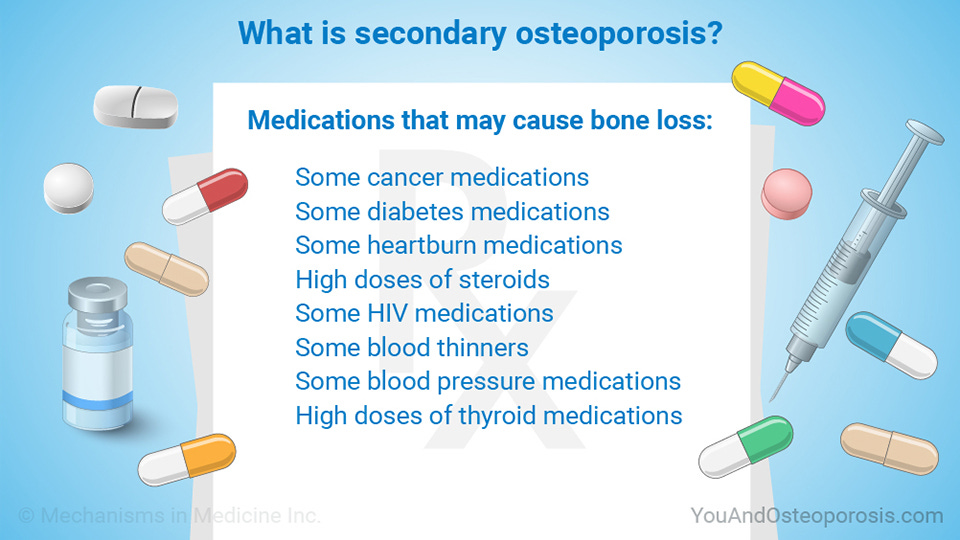 Slide Show - Understanding Bone Health and Osteoporosis