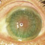Blerpharospasm