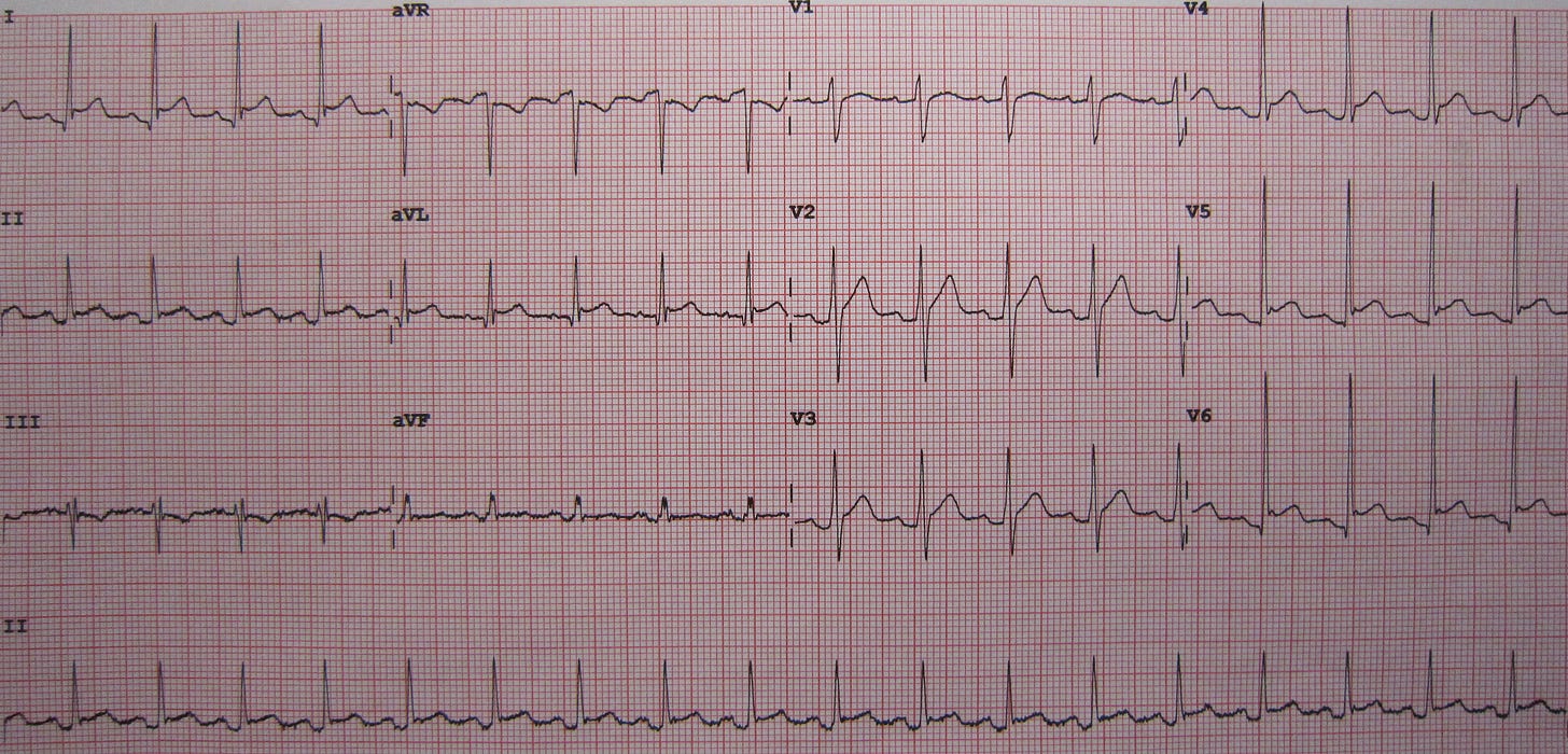 https://upload.wikimedia.org/wikipedia/commons/7/7e/Pericarditis10.JPG https://upload.wikimedia.org/wikipedia/commons/7/7e/Pericarditis10.JPG