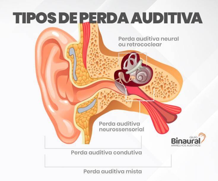 tipos de perda auditiva binaural