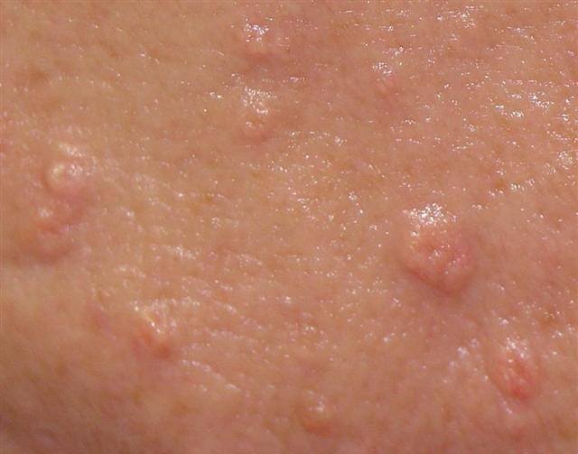 Sebaceous Gland Hyperplasia (SGH) - Dermatology Surgery Center - Niceville,  FL (Bluewater Bay)