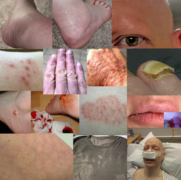 Various skin conditions, arthritis, and inflammation on Pete Jorgensen's body