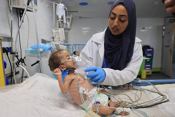 Palestinian child suffering from malnutrition is treated by a nurse at the Nasser hospital in Khan Yunis in the southern Gaza Strip on July 10 amid...