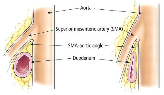 Superior Mesenteric Artery Syndrome Research and Awareness