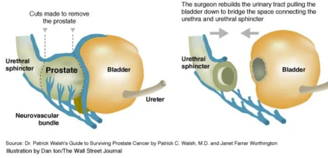 Urethra, prostate, bladder before and after nerve-sparing surgery, showing the nerves requiring sparing.