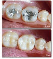 Mercury Amalgam Fillings Compared to ...