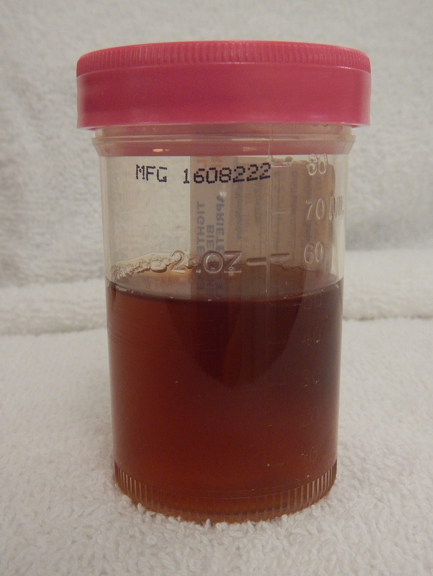 Hematuria - Wikipedia