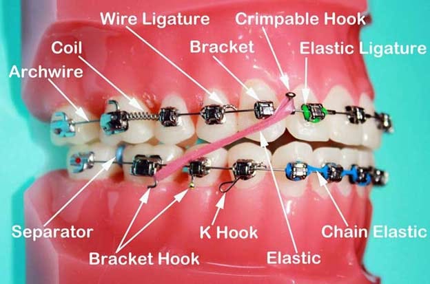 Taking Care Of Braces | Webb & Goldsmith Orthodontics