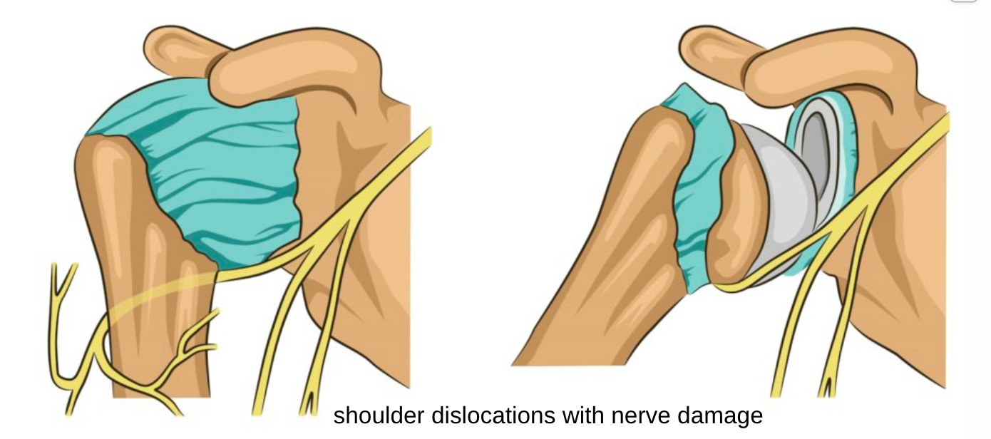 Ed's Dislocation Neurological Manifestations of EDS
