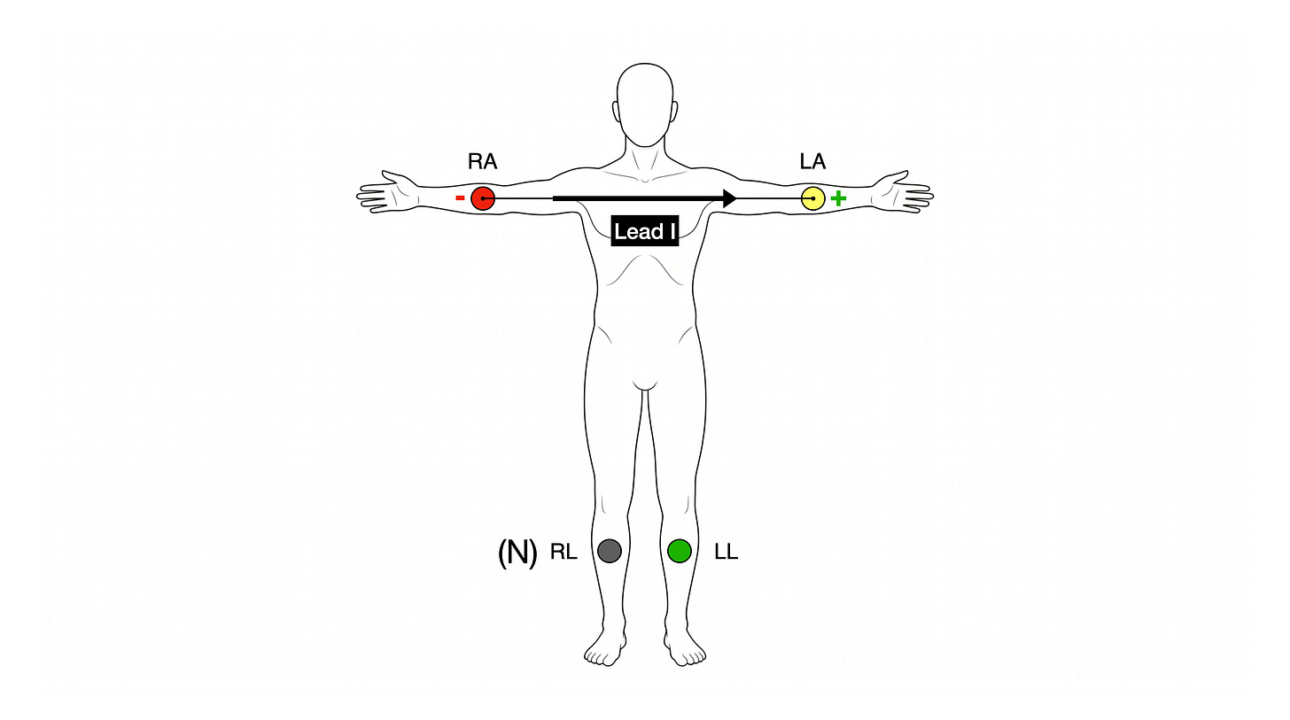 Front-view torso with limb electrodes labelled RA (red), LA (yellow), LL (green), and N RL (black). A horizontal black arrow runs from the RA electrode to the LA electrode and is labelled Lead I. The LA electrode is marked (+) and the RA electrode (−).
