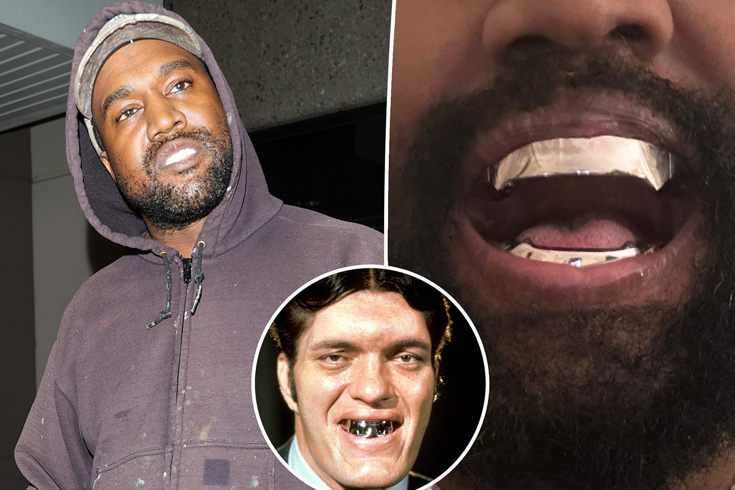 Kanye West has teeth removed and replaced with $850K titanium dentures  modeled after James Bond spy