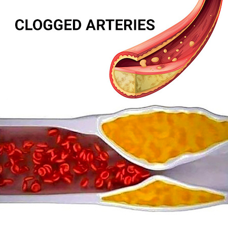Clogged Arteries: What Causes Them and Why They Are Dangerous? - New York  Cardiac Diagnostic Center in New York City 1
