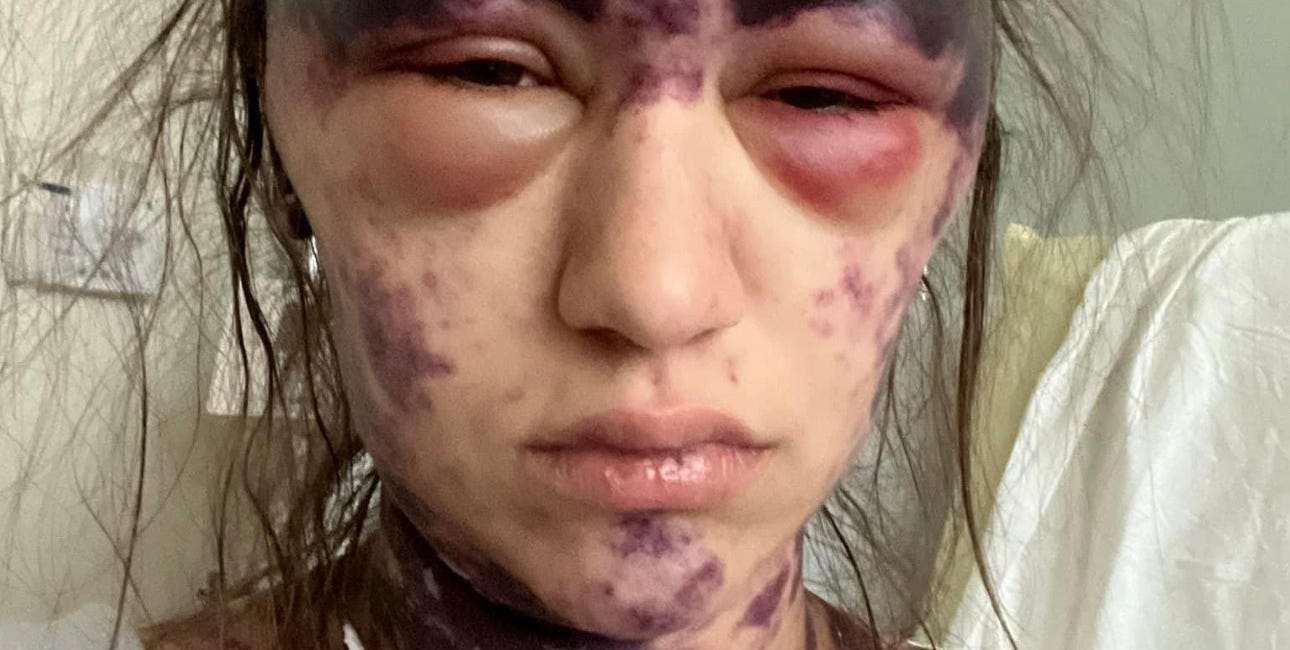 Update on Alexis Lorenze, September 22, 2024