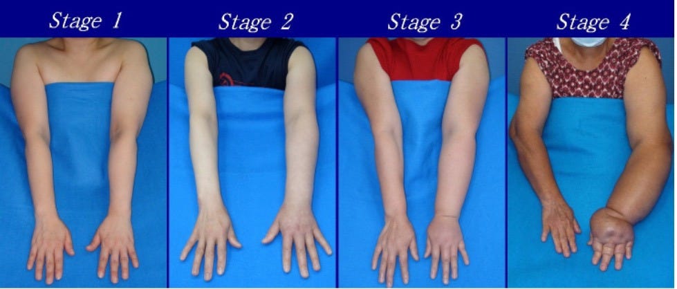 Postsurgical Arm Care to Prevent Swelling and Lymphedema | ACS