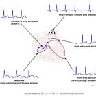 SVT is not a diagnosis