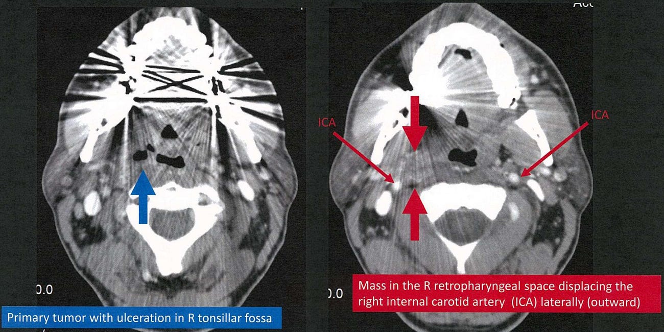 Carotid Blowout Syndrome [Oncology]