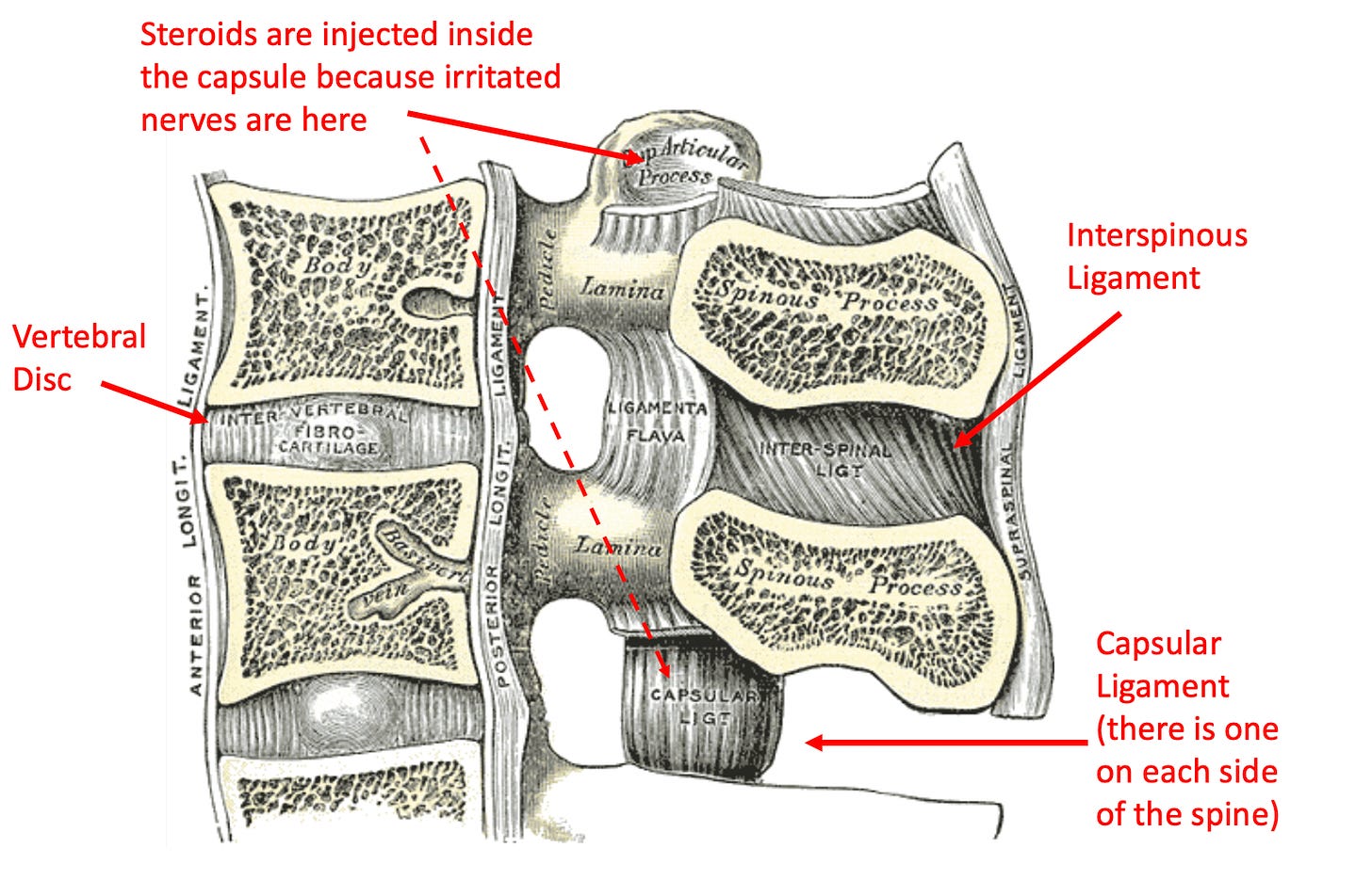 Spinal Stacking The Many Dangers of Spinal Surgery - by A Midwestern Doctor