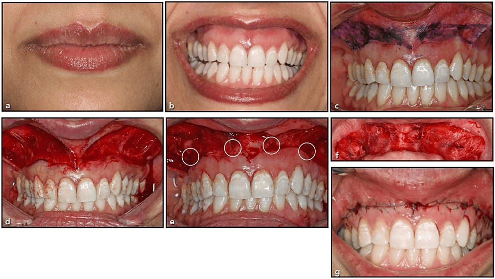 (a-g)-Surgical-procedure-in-the-test-group (a-g)-Surgical-procedure-in-the-test-group